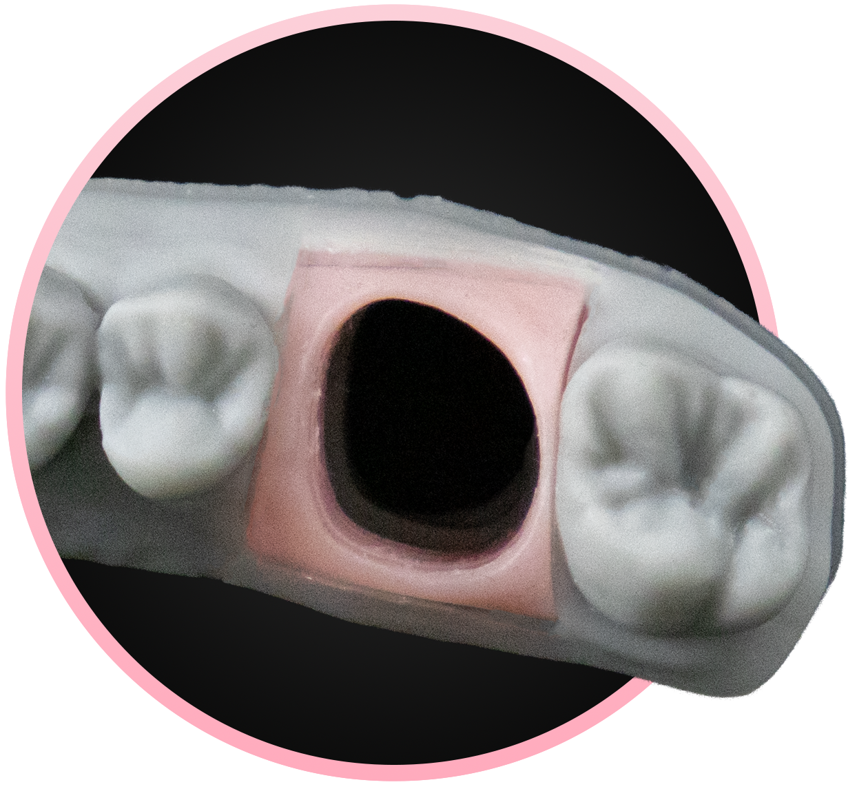 Resina Composita Dentale Goldenkey – Tonalità Opaca Rosa Per Gengive E Protesi