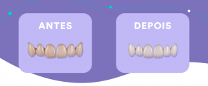 Checklist de acabamento estético em facetas: 7 pontos para um resultado mais natural